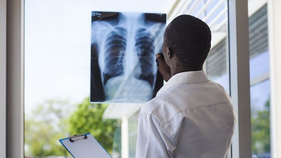 How To Avoid Pulmonary Nodules